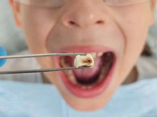 Best Emergency Tooth Extraction in Waterloo, IA
